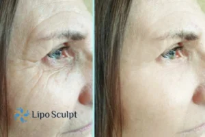 How to Fight Aging Symptoms 2 Do you want to Fight Aging Symptoms Warfield? Contact Lipo Sculpt today!