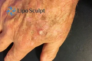 Best Actinic Keratoses Removal 2 Improve your wellbeing and health with Actinic Keratoses Warfield removal.treatment
