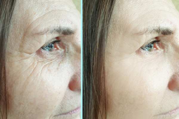 Why Do People Choose HIFU for a Non-Surgical Facelift? 4 How long can HIFU results last Warfield?