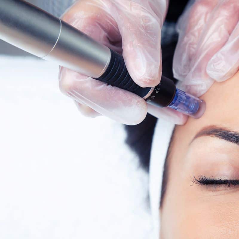 Morpheus8 treatment Warfield from Lipo Sculpt - Book in today!