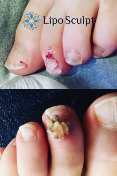 Wart removal customer results from Lipo Sculpt Warfield