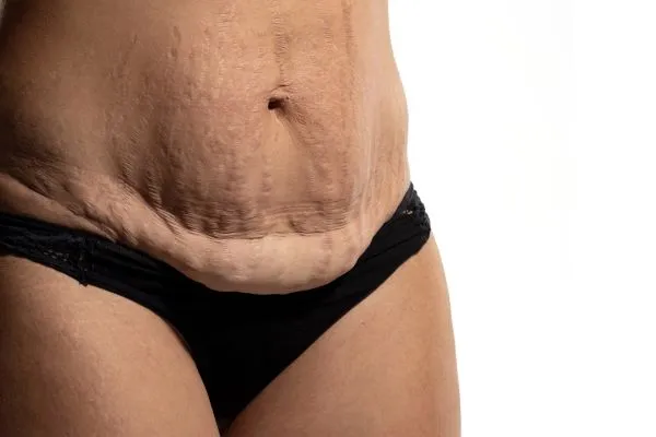 Lost the Weight but Not the Loose Skin? 1 image of womans stomach after weight loss showing loose skin Warfield